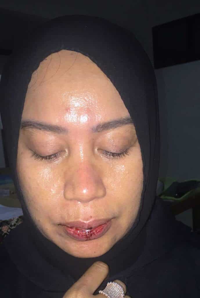 Oknum Kadis Perindagkop dan UKM Manokwari Belum Juga Ditahan, LP3BH Manokwari: Kepastian Hukum Diduga Sudah Mati Nur Alim Korban Penganiayaan 689x1024 1 Sengkarut kasus penganiayaan oknum Kadis Perindagkop dan UKM Manokwari, Yan Ayomi tersangka di Polresta Manokwari, LP3BH Manokwari